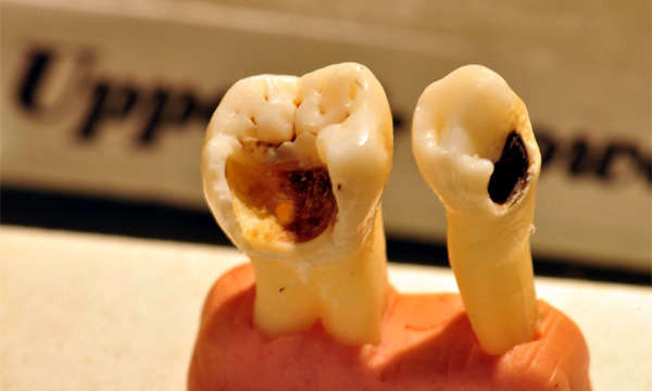 RCT endodontics courses jaipur